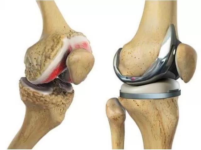 Fast-Track Knee Replacement(best orthopedic doctor)